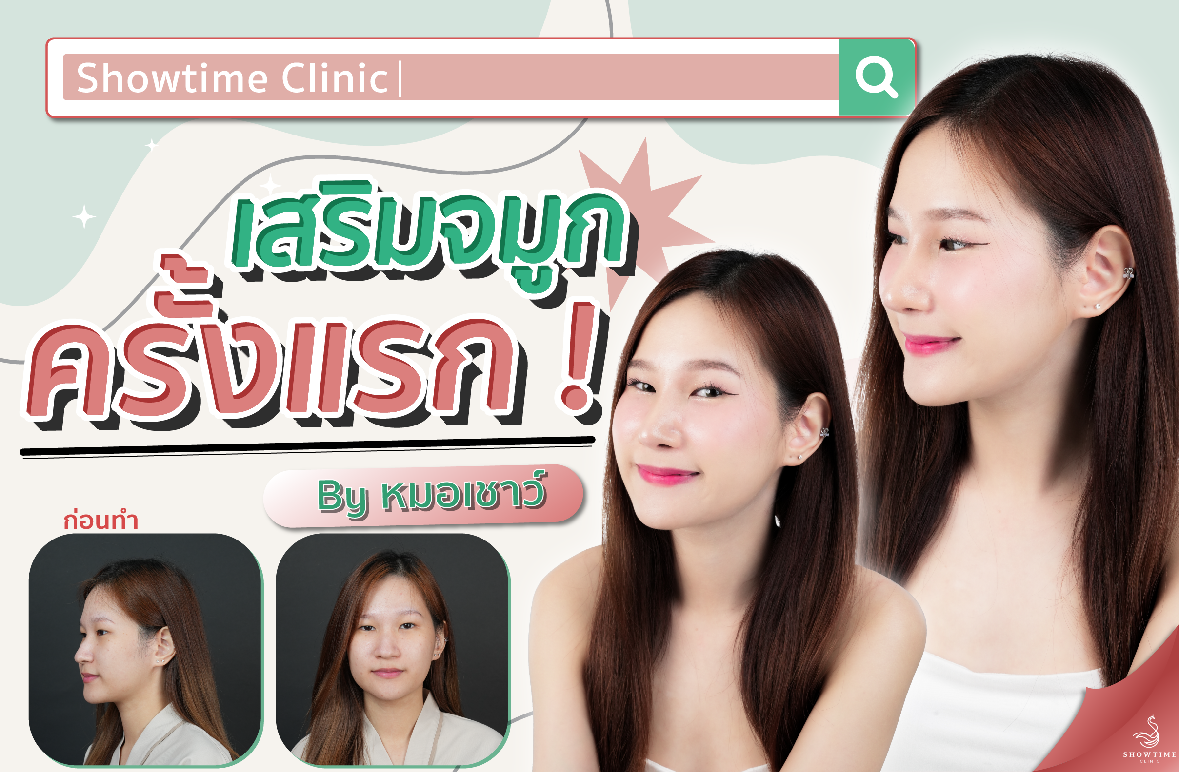 เสริมจมูก ครั้งแรก