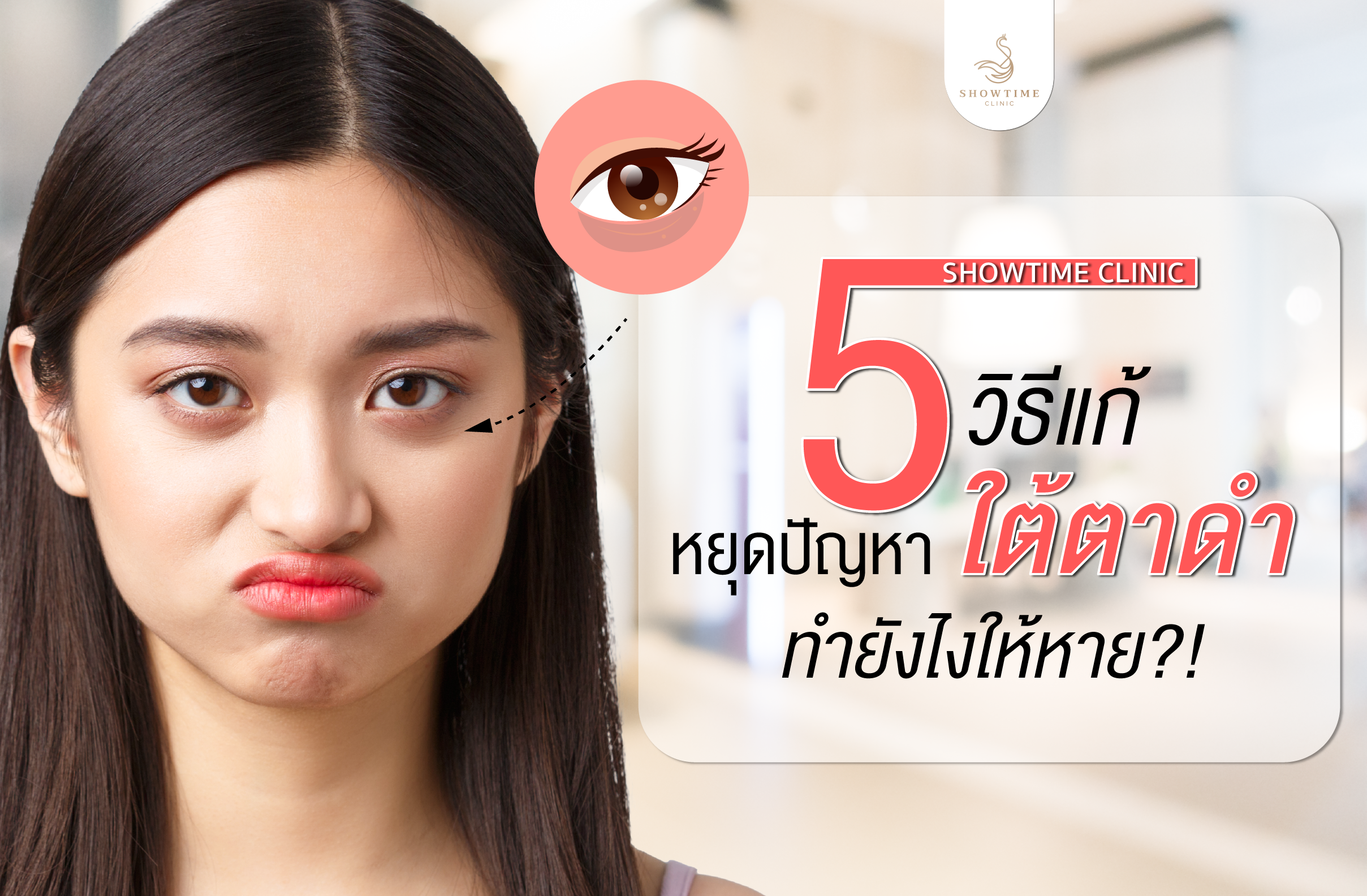 ใต้ตาดำ – 5 วิธีแก้ หยุดปัญหาใต้ตาดำ ทำยังไงให้หาย?!