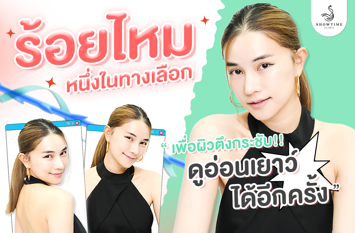 ร้อยไหม (Thread Lift) หนึ่งในทางเลือก เพื่อผิวตึงกระชับ…กลับมาดูอ่อนเยาว์อีกครั้ง!