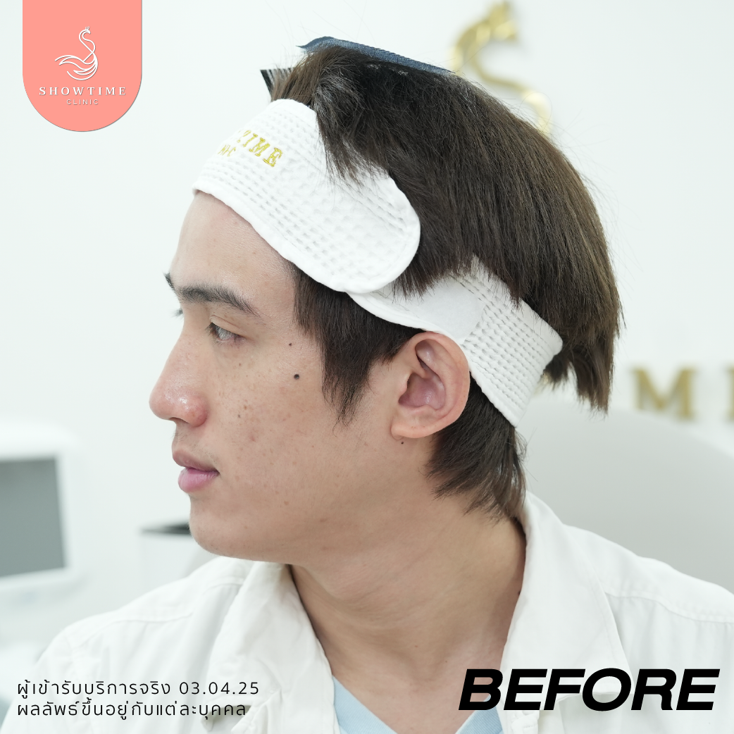 โบท็อก ลดไขมัน