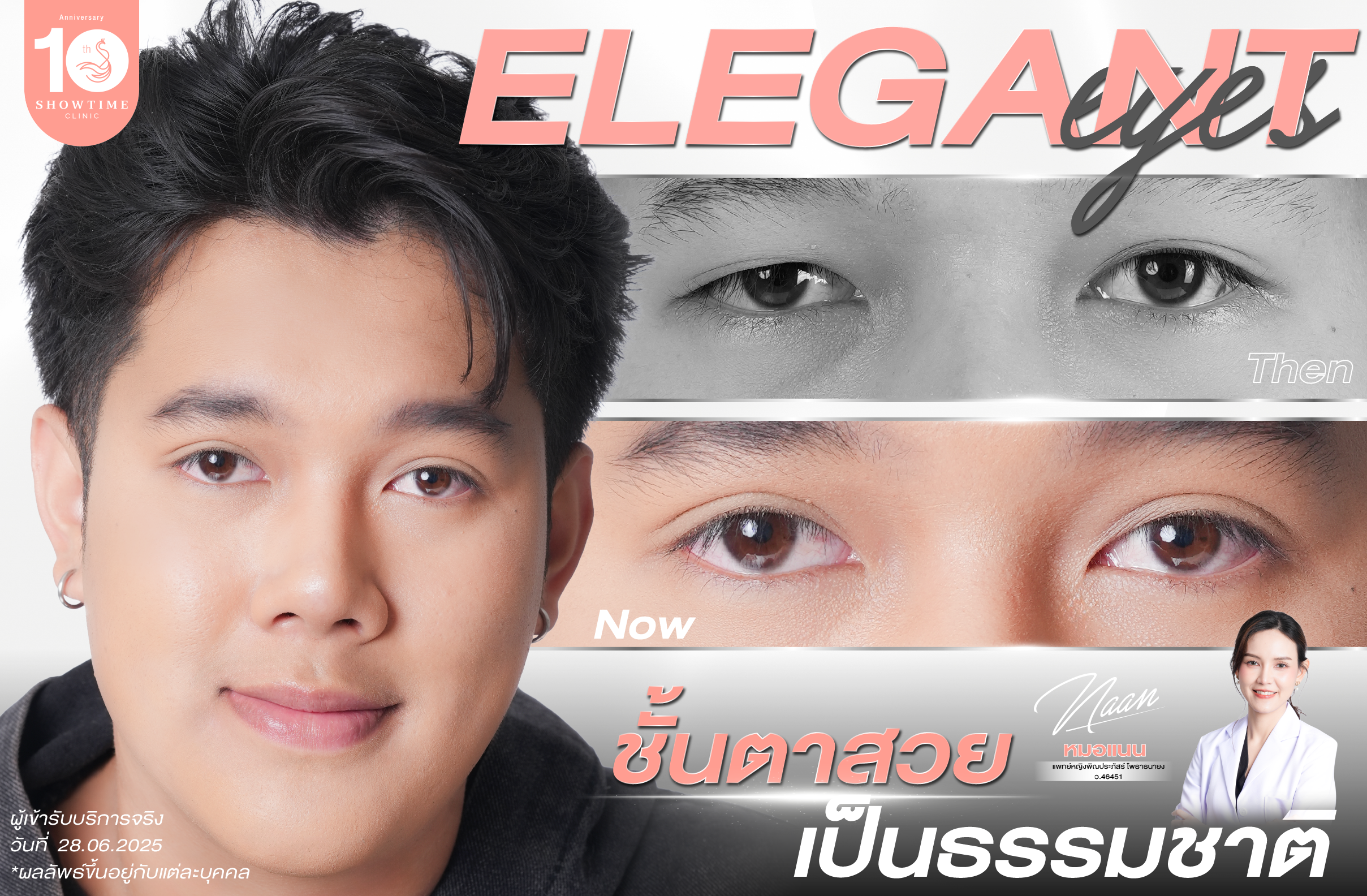 รีวิว คุณตี่ทำตาสองชั้น Elegant Eyes กับหมอแนน Showtime Clinic