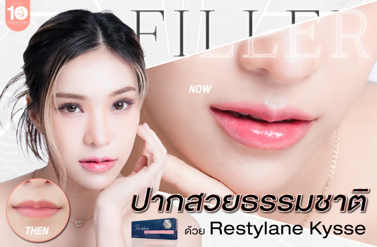 คุณพิมพ์ ฟิลเลอร์ปากสวยธรรมชาติ ด้วย Restylane Kysse ที่ Showtime Clinic