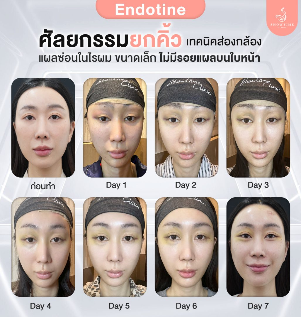 เอนโดไทน์/Endotine