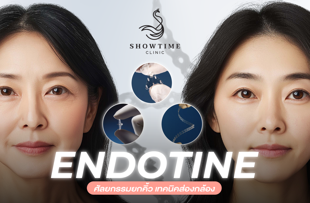 เอนโดไทน์/Endotine