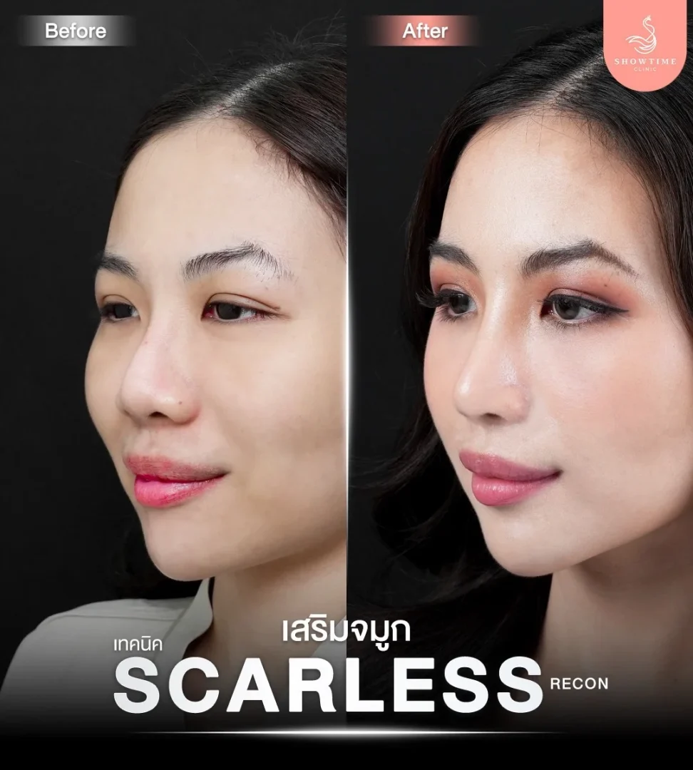 รีวิวแก้จมูกชมพู่ 