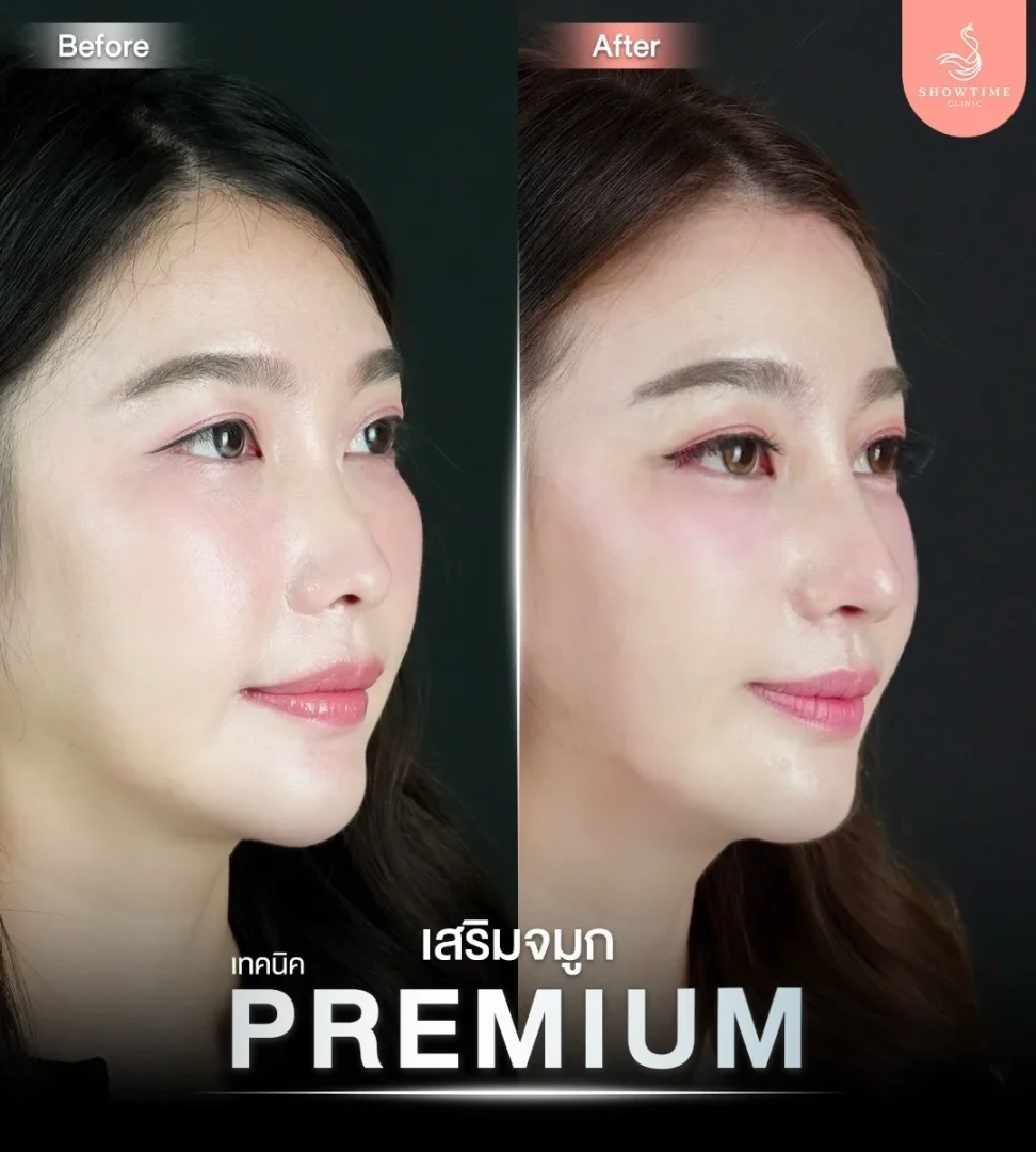 รวมรีวิวเสริมจมูกพรีเมี่ยม 1