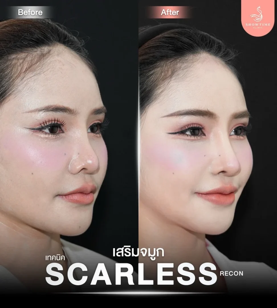 รีวิวงานแก้จมูก