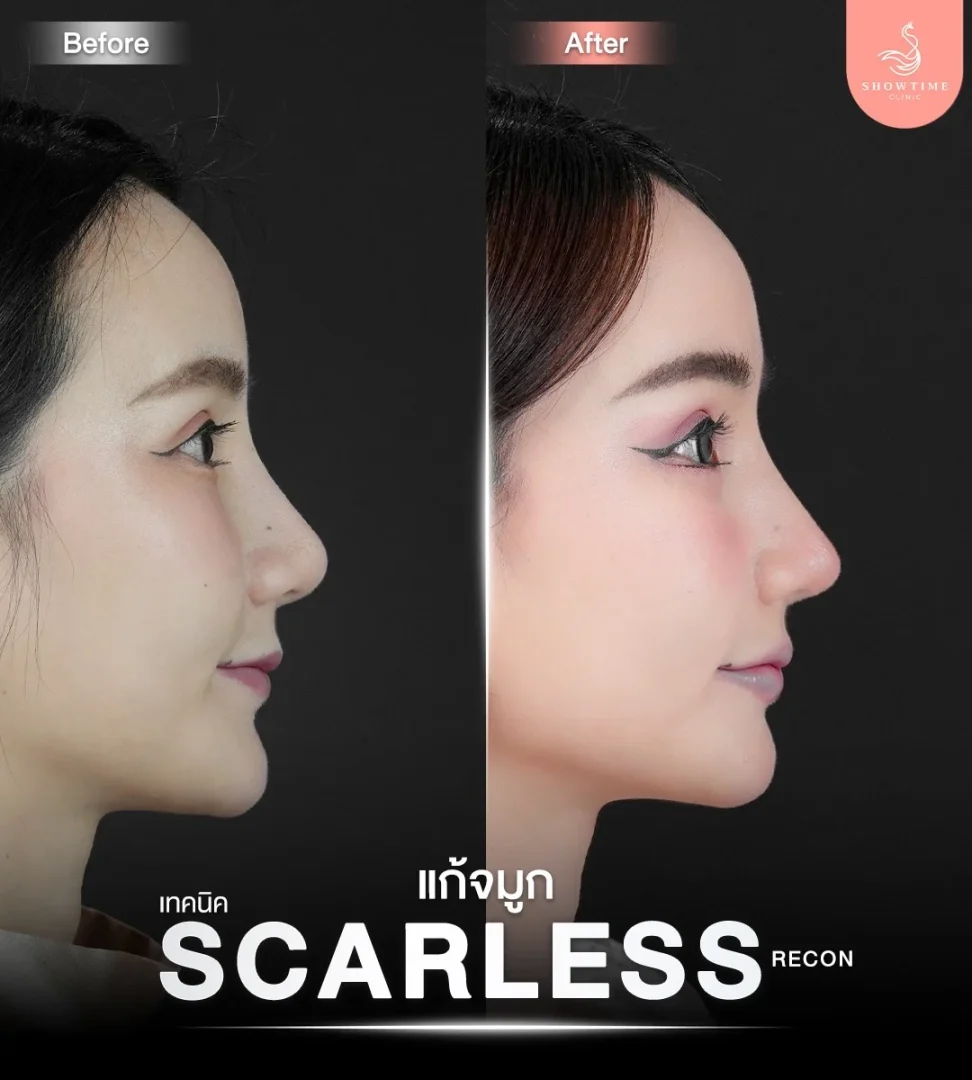 รีวิวแก้ไขโครงสร้าง ไร้รอยแผล (Scarless Recon) 1