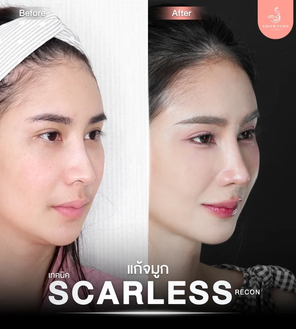 รีวิวแก้ไขโครงสร้าง ไร้รอยแผล (Scarless Recon) 2