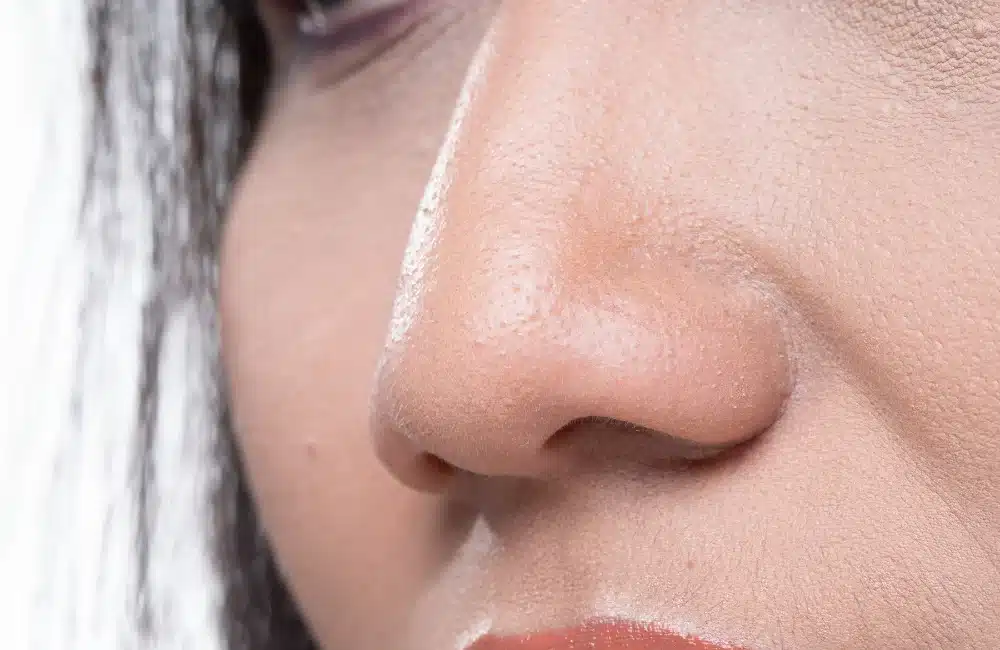 สาเหตุของจมูกชมพู่ เกิดจากอะไร