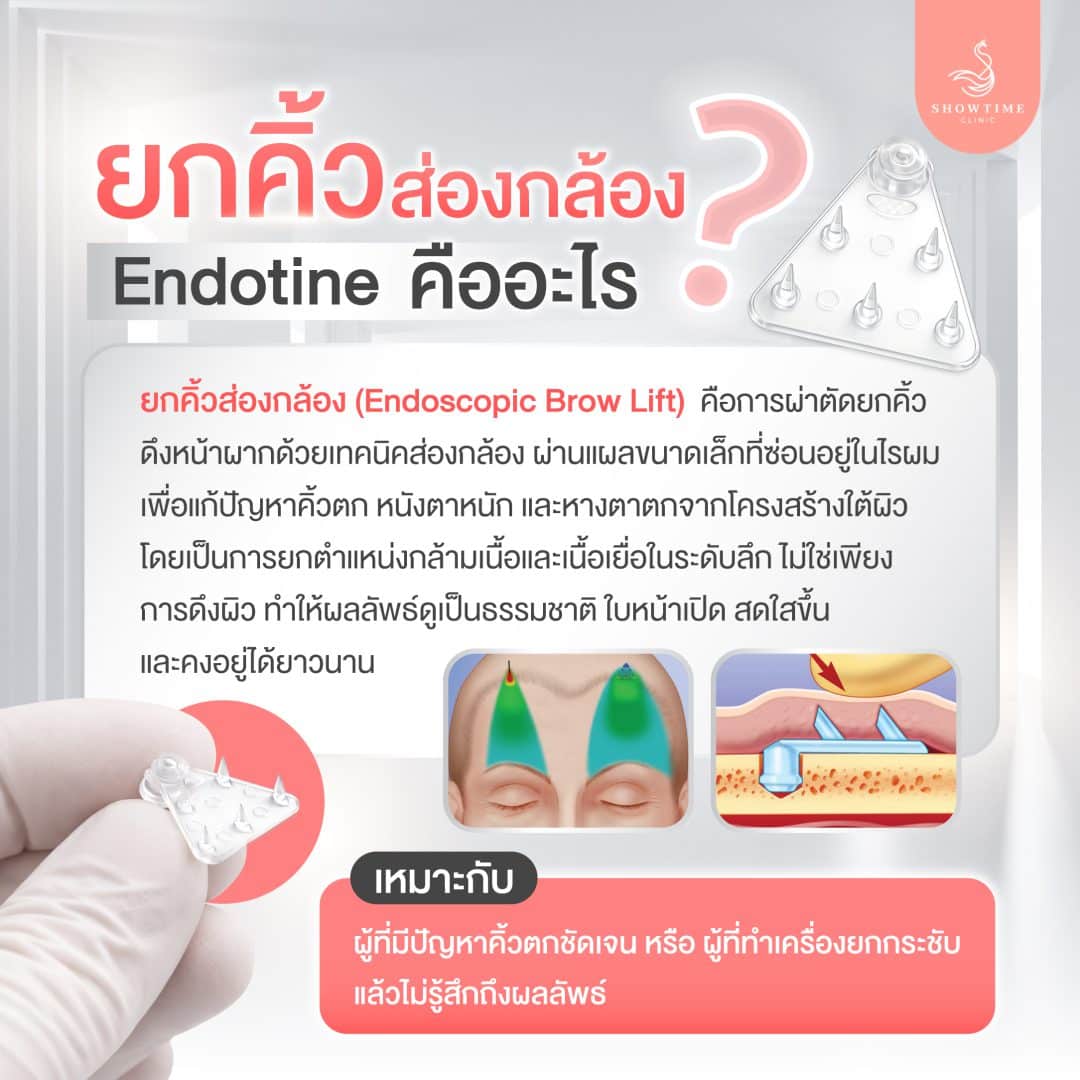 ยกคิ้วส่องกล้อง Endotine