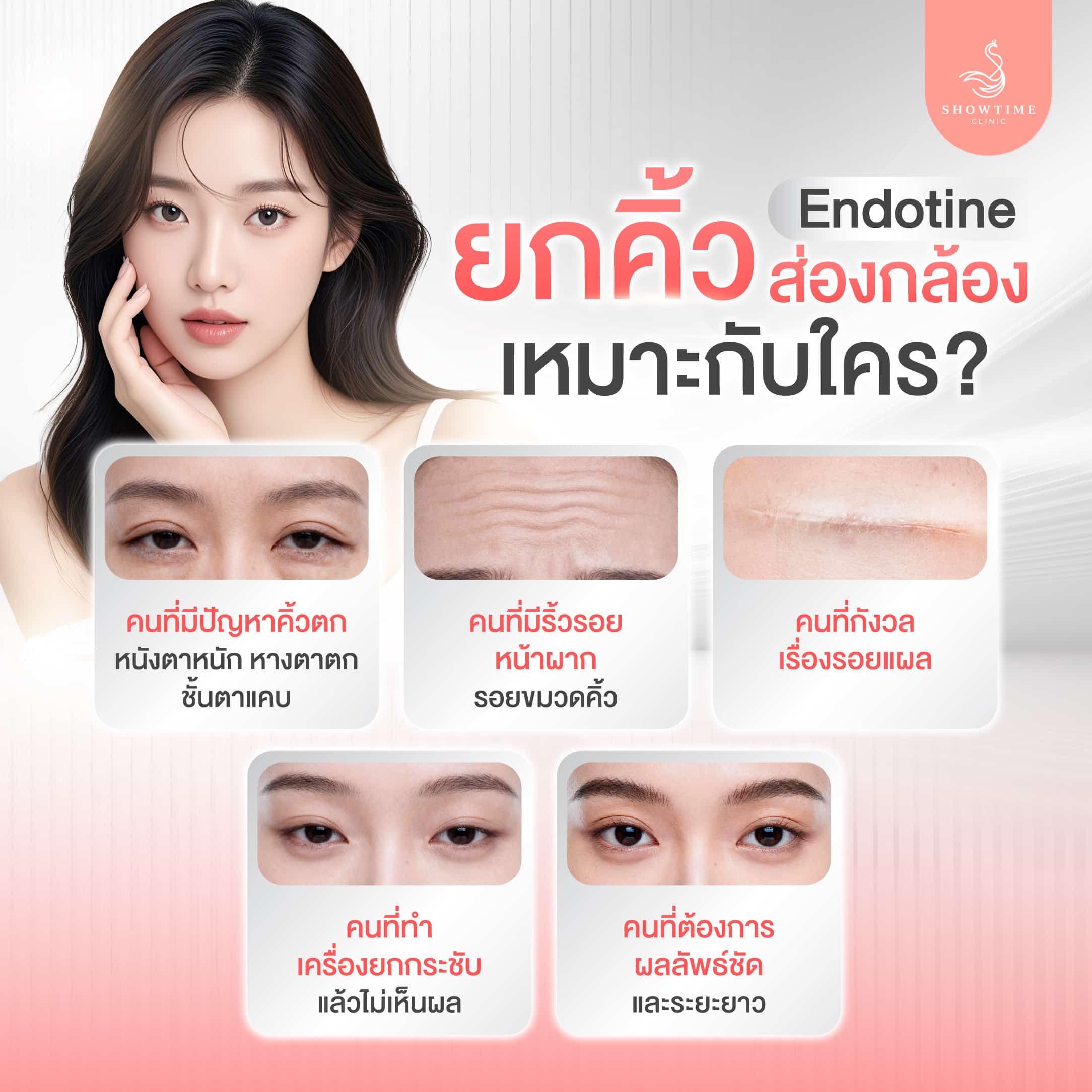 ยกคิ้ว Endotine เหมาะกับ