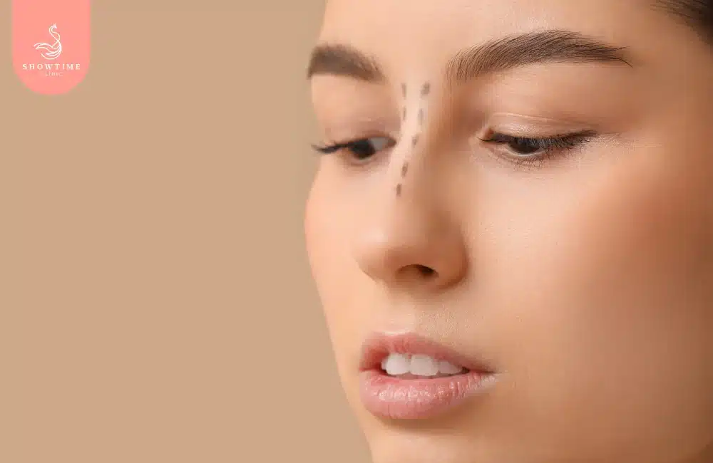 การดูแลตัวเองหลังแก้จมูกแบน