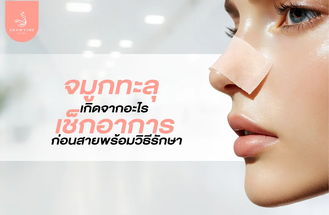 จมูกทะลุ เกิดจากอะไร เช็กอาการเตือนก่อนสาย พร้อมวิธีรักษา
