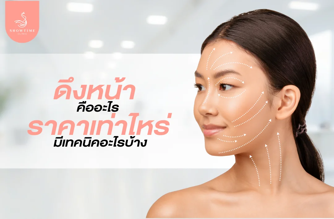 ดึงหน้า (Facelift) คืออะไร