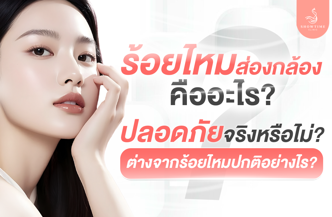 Thread Lift ร้อยไหมส่องกล้อง