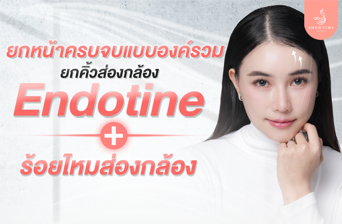 ยกคิ้วส่องกล้อง Endotine กับ ส่องกล้องร้อยไหม