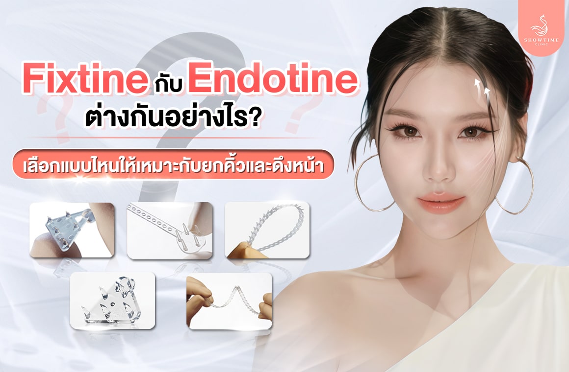 Fixtine vs Endotine