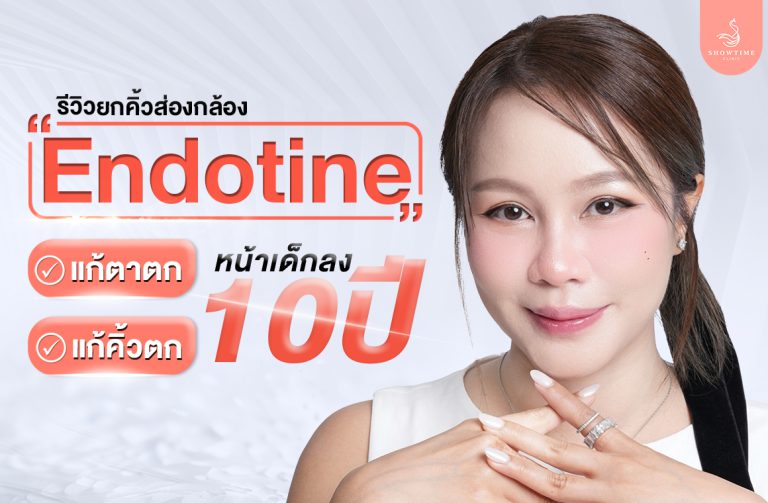 Endotine-Review