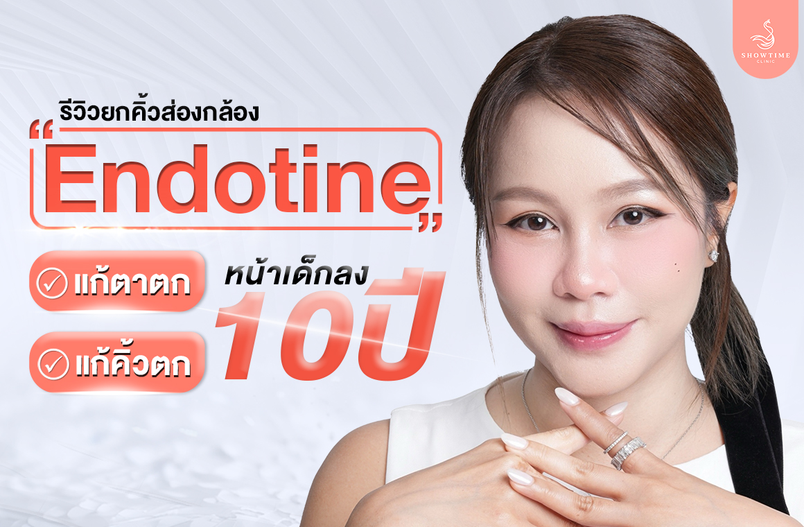 Endotine-Review